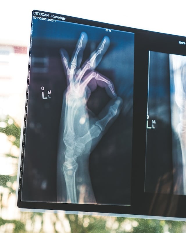рентгеновский снимок кисти руки, демонстрирующий прекрасное состояние костей
